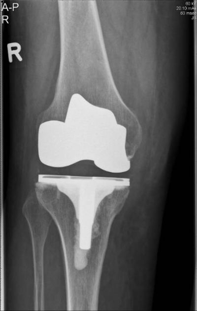 Smith & Nephew Journey (Implant 609)